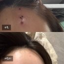 상포 | 얼굴흉터치료 대구대상포진피부과 새살침으로 깊은 흉터제거