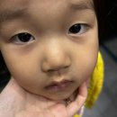 아이레이저랩 | 부산 아기 봉합흉터레이저, 4-5차 / 로아르피부과