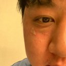 하나성형외과의원 | 다크써클을 뿌시자! [반니성형외과의원] 눈밑지방레이저 시술 후기