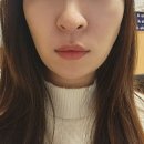 (주)원유니버스 | 강남피부과 슈링크유니버스 300샷 이중턱 효과 가격 통증 2주 경과 후기