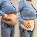 [공지] 대구 복부 지방흡입 2달 동안 변화 총 14kg 감량 다이어트 후기+가격 공유
