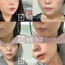 명동피부과 2주차 온다리프팅후기