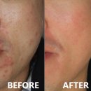 서울ND(엔디)의원 | [강남 피부과] 남자 수염 제모 왜 효과 없다고 느낄까? 진짜 후기 공개