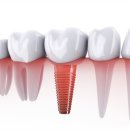 세기치과기공소 | 소사벌 임플란트? 3년 만에 재수술하는 이유