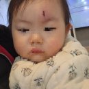 SM미성형외과의원 | 상무지구봉합병원 아기봉합수술 SM미성형외과의원