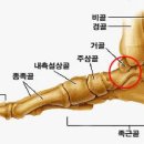 거골 경부 골절의 정의, 증상, 원인 및 치료 이미지