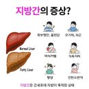 지방간의 진단과 관리 이미지