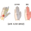 손목수근관증후군 (Carpal Tunnel Syndrome) 이미지