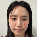 효성의원 | 기미·점·쥐젖·사마귀 등 레이저 역대급 가성비, 2회차 오픈런 성공 후기!+예약꿀팁 포함 [효성의원]
