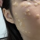 연세의원 | [하남]연세미담의원 편평사마귀 제거 후기 : CO2 레이저 비용 및 시술 과정 기록1