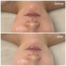 도봉-쌍문-도봉-1392 | 수유 쌍문 피부관리 리애나뷰티 윤곽 마사지 고주파 리프팅효과