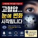 맑은빛성모안과의원 | 고혈압과 눈 관계, 대부분이 놓치는 위험 신호를 송탄안과, 송탄성모안과에서 알려드릴께요
