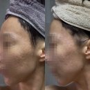 (주)펄스 | 울트라펄스 알파 여드름 흉터 시술 1회차 한달 경과 후기