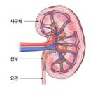 사구체신염 (Glomerulonephritis) 이미지
