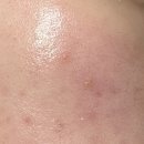 블리비의원 | 발산역 피부과 블리비의원 안아픈 압출 여드름 관리 후기