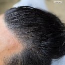센스헤어 | 광교 탈모관리 닷센스 용인광교점 헤어라인 커버 SMP 후기