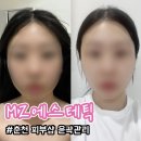 봄내병원 | 춘천 피부샵 MZ에스테틱 윤곽관리 드라마틱한 추천 후기