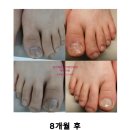 제성한의원 | 발톱무좀·내성발톱 동시 치료 사례 — [파주]일산 치유본의원한의원-메디컬오의원으로 상호만 변경”