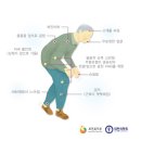 ■ 파킨슨병(Parkinson`s Disease) 원인.증상.진단.치료 이미지