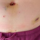 남5통(신기) | [자궁내막증 #11] 복강경 수술 후 6주간의 기록 : 회복기 증상, 절대안정(중요), 지역채혈