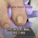 포쉬네일이마트 - 7709 | 서산 내성발톱 관리, 효과 없는 곳들의 공통적인 특징