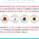 유행성 결막염 여름철 유행성결막염 원인 여름철 눈병 주의 유행성결막염 이미지