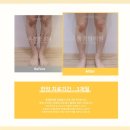 동경한의원 | 다리, 피부에 붉은 반점이 생기고 가려움증까지 있다면? 혈관염 자반증 의심전 확인사항 <필독>