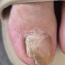 두마리토끼 | 발톱 무좀과 내성 발톱 동시 케어 가능, 두마리 토끼 잡은 케어 후기