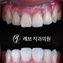 스마일라인치과기공소 | [공지] 레브네이트 마스터 ; 예비신랑 앞니 무삭제라미네이트. 신사역 치과. 치료후기/비용/가격.