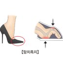 망치족지(Hammer toe) 근골격 질환이란? 이미지