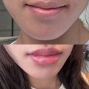 남대전푸른문고 | 대전바노바기 입술필러 가격 멍 붓기 등 찐후기 (강추)