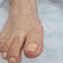 고양내성발톱 효과 좋은 전문관리 풋네일