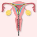 서울소망의료소비자생활협동조합 서울소망의원 | 자궁동맥색전술 절제하지 않는 UAE