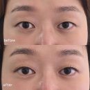 사하구-37 | 사하구속눈썹 자연스럽게 잘하는 곳 린케이 사하점 클리닉펌 후기