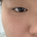 율무 | 쥐젖,비립종 고민 끝 | 닥터비기닝 율작 율무 크림 사용 후기🌟