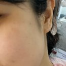 미솔 | [ 김해피부관리 ] 김해 여드름 경찰 청소년 여드름 전문인 피부 도로공사 받고 온 후기 &#34;미솔피부관리실&#34;