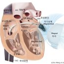 의과학 소식: 뇌졸중 예방-심장 주입 磁氣 젤 이미지