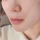 제일편안의원 | 강남구청역 피부과의원 리니어지 600샷 시술 통증 및 일주일 후기