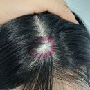 서면메트로약국 | [20대 여자 탈모치료]전국에서 찾아오는 경남 마산 탈모 전문 병원 2년 6개월 차 후기/ 전후 비교 사진
