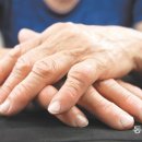 건강 : 손가락 마디 붓고 극심한 통증, 류머티즘관절염 이미지