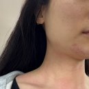 효성의원 | 결혼준비)경산 평일 점 제거 효성 의원 다녀옴(눈치게임 성공)-후기사진, 가격공개