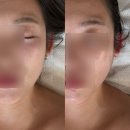 뷰티엠 | 서울 화곡동 아이엠파인 뷰티스튜디오 턱살리프팅 딱프팅 추천후기