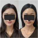 천안피부관리 청당동 ‘ 가인뷰티 에스테틱 ’ 비대칭 윤곽관리 후기