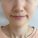 클린포엘 모공앰플 3주후기, 늘어진 모공 때문에 써본 리얼 사용기