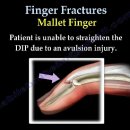 Mallet Finger Fracture 이미지