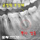 &#34; 신경치료 후 크라운 , 미루면 이렇게 됩니다.&#34; 불당동 발치 후 임플란트 후기