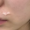 1. 비후성반흔 흉터제거수술 병원 후기