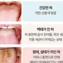입냄새제거 5가지 입냄새원인 이것만 조심해도 이미지