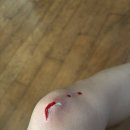 엔씨피희망약국 | 강남차병원 유방외과 맘모톰 수술 섬유선종 조직검사 후기