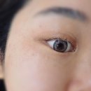 11260-2-4-10 | 중랑구 면목동 기미잡티제거 중계미작뷰티 제로스팟 클리어스팟프로 후기